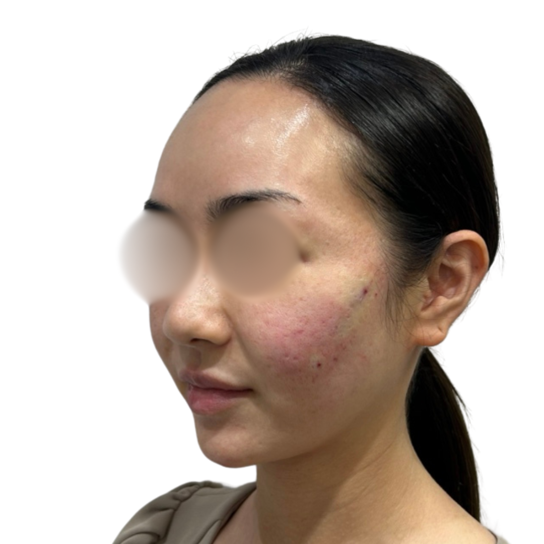 サブシジョン（クレーター治療）